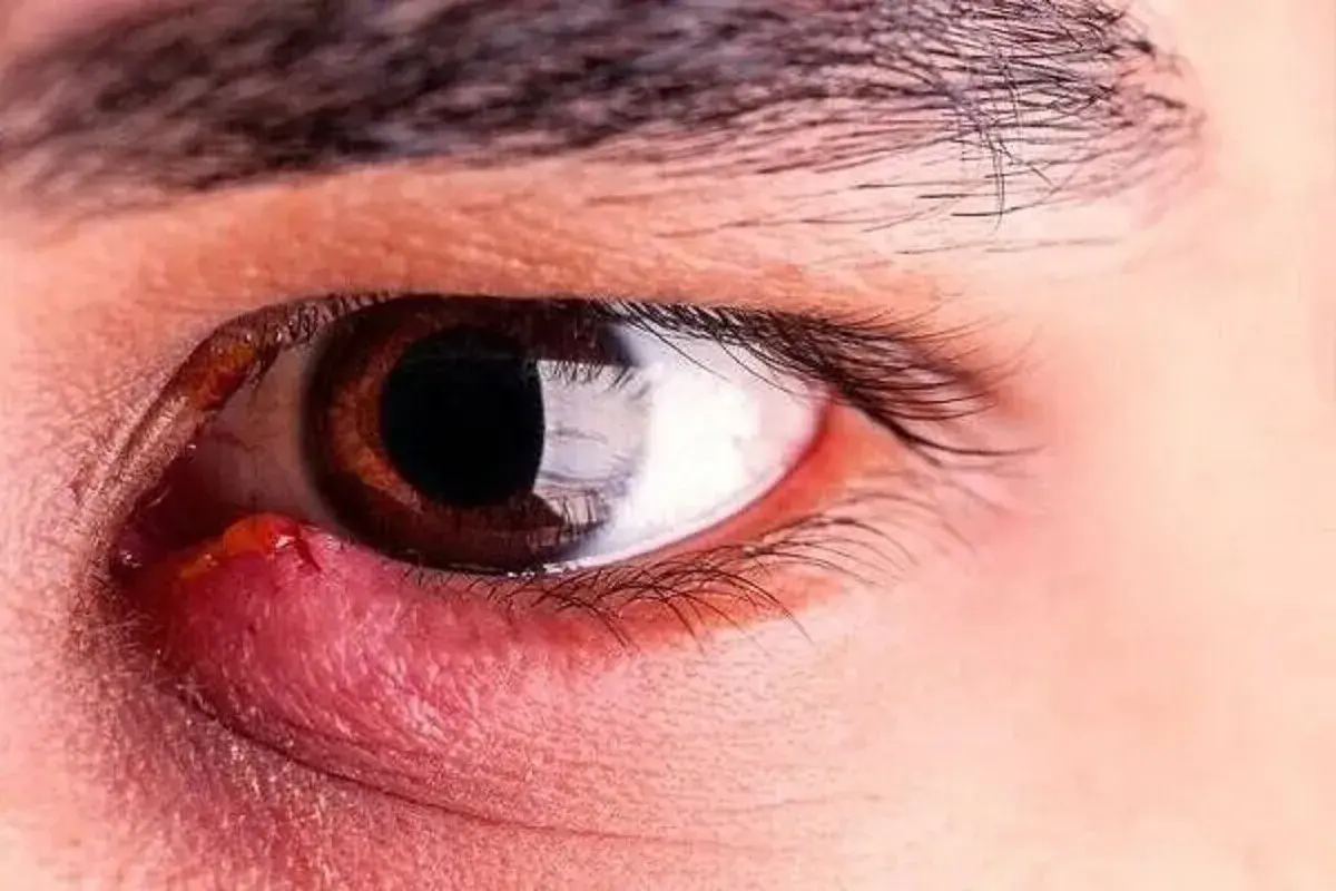 هشدار درباره یک عارضه شایع چشمی / گلمژه را جدی بگیرید